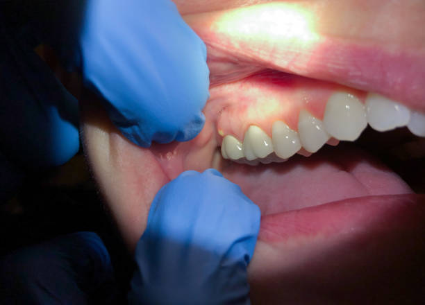 Best Emergency Treatment for Oral Infections in Morton, WA