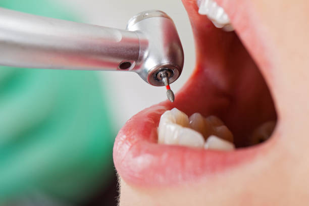 Best Emergency Wisdom Tooth Extraction in Morton, WA